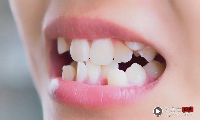 Tips I 食物经常塞牙缝？可能跟这5种口腔病有关 更多热点 图5张